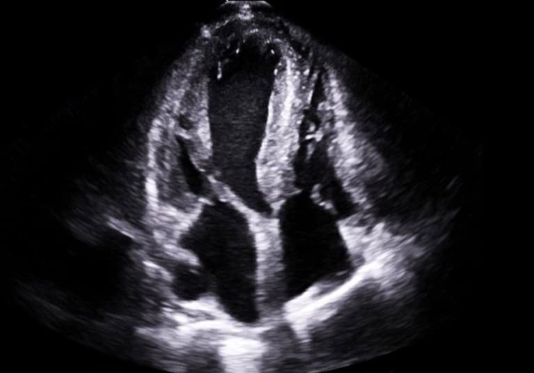 AI Screening for Cardiac Amyloidosis: FAQ