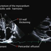 Artificial intelligence model detecting cardiac amyloidosis from echocardiographic video clip.
